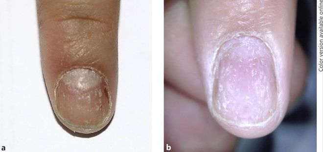 孩子指甲软薄易断、月牙少、长白点、竖纹是显示身体有健康风险吗？(图7)