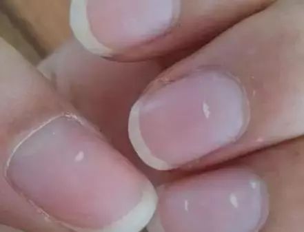 孩子指甲软薄易断、月牙少、长白点、竖纹是显示身体有健康风险吗？(图6)