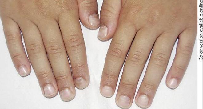 孩子指甲软薄易断、月牙少、长白点、竖纹是显示身体有健康风险吗？(图10)