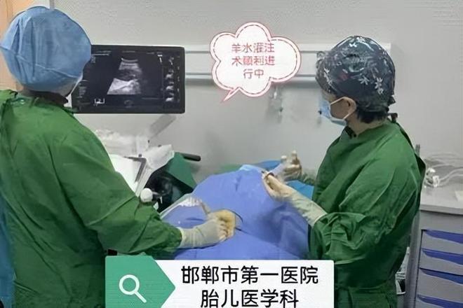 【邯郸首例】邯郸市第一医院成功实施胎儿羊水灌注术(图2)